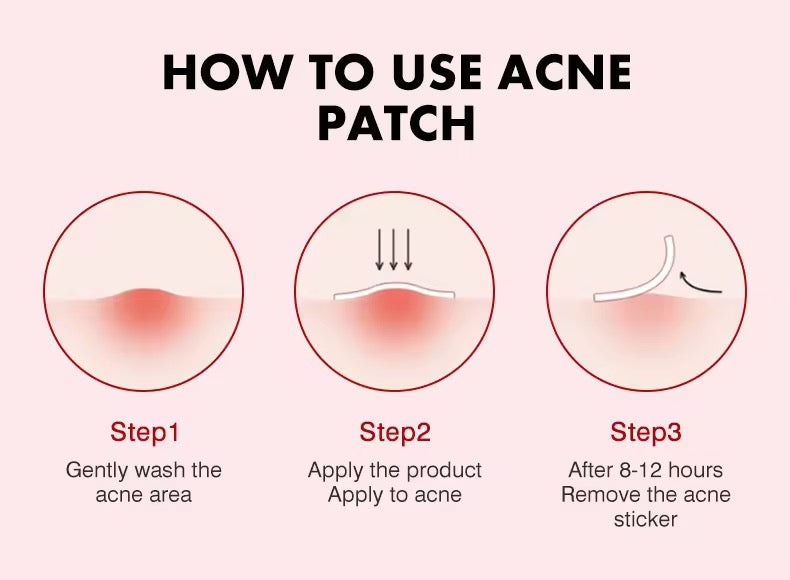 MOIKA Herbal Hydrocolloid Salicylic Acid Acne Patches Pimple Whitehead Facial Acne Removal 36 Patches Boxed for Wholesale